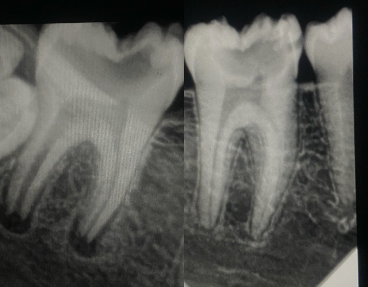 mo_mtaz12345's tweet photo. Vital pulp therapy for lower right(6,7) ,13 years old patient  incomplete root formation at lower 7 so vital pulp therapy,using (MTA,RMGI) followed by composite restoration .

#momtaz_dental_clinic
#خلى_ضحكتك_احلى
Insta https://t.co/5kjR30I5UM
TikTok: https://t.co/pmFwnRd2UL https://t.co/H54xfPi5Gz