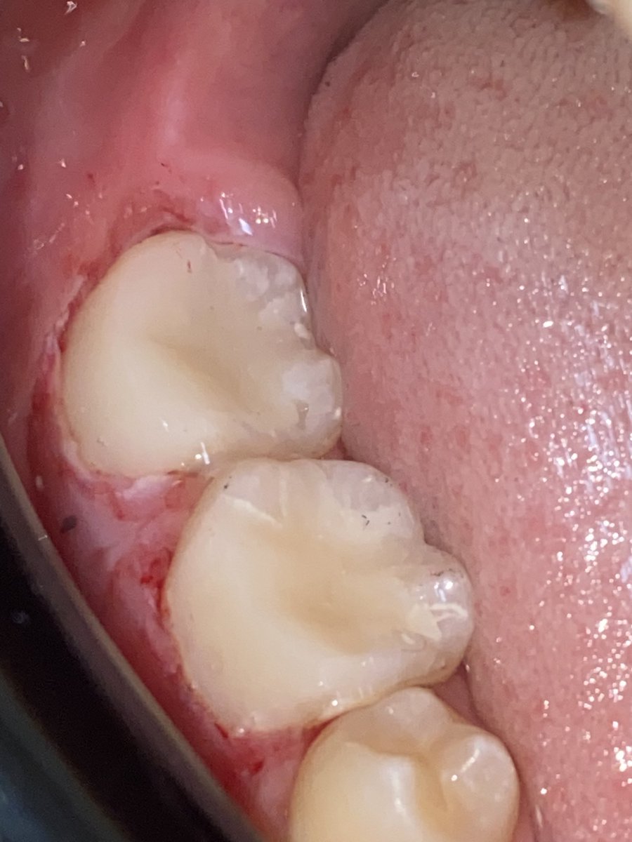 mo_mtaz12345's tweet photo. Vital pulp therapy for lower right(6,7) ,13 years old patient  incomplete root formation at lower 7 so vital pulp therapy,using (MTA,RMGI) followed by composite restoration .

#momtaz_dental_clinic
#خلى_ضحكتك_احلى
Insta https://t.co/5kjR30I5UM
TikTok: https://t.co/pmFwnRd2UL https://t.co/H54xfPi5Gz
