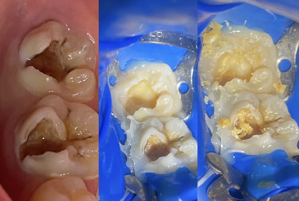 mo_mtaz12345's tweet photo. Vital pulp therapy for lower right(6,7) ,13 years old patient  incomplete root formation at lower 7 so vital pulp therapy,using (MTA,RMGI) followed by composite restoration .

#momtaz_dental_clinic
#خلى_ضحكتك_احلى
Insta https://t.co/5kjR30I5UM
TikTok: https://t.co/pmFwnRd2UL https://t.co/H54xfPi5Gz