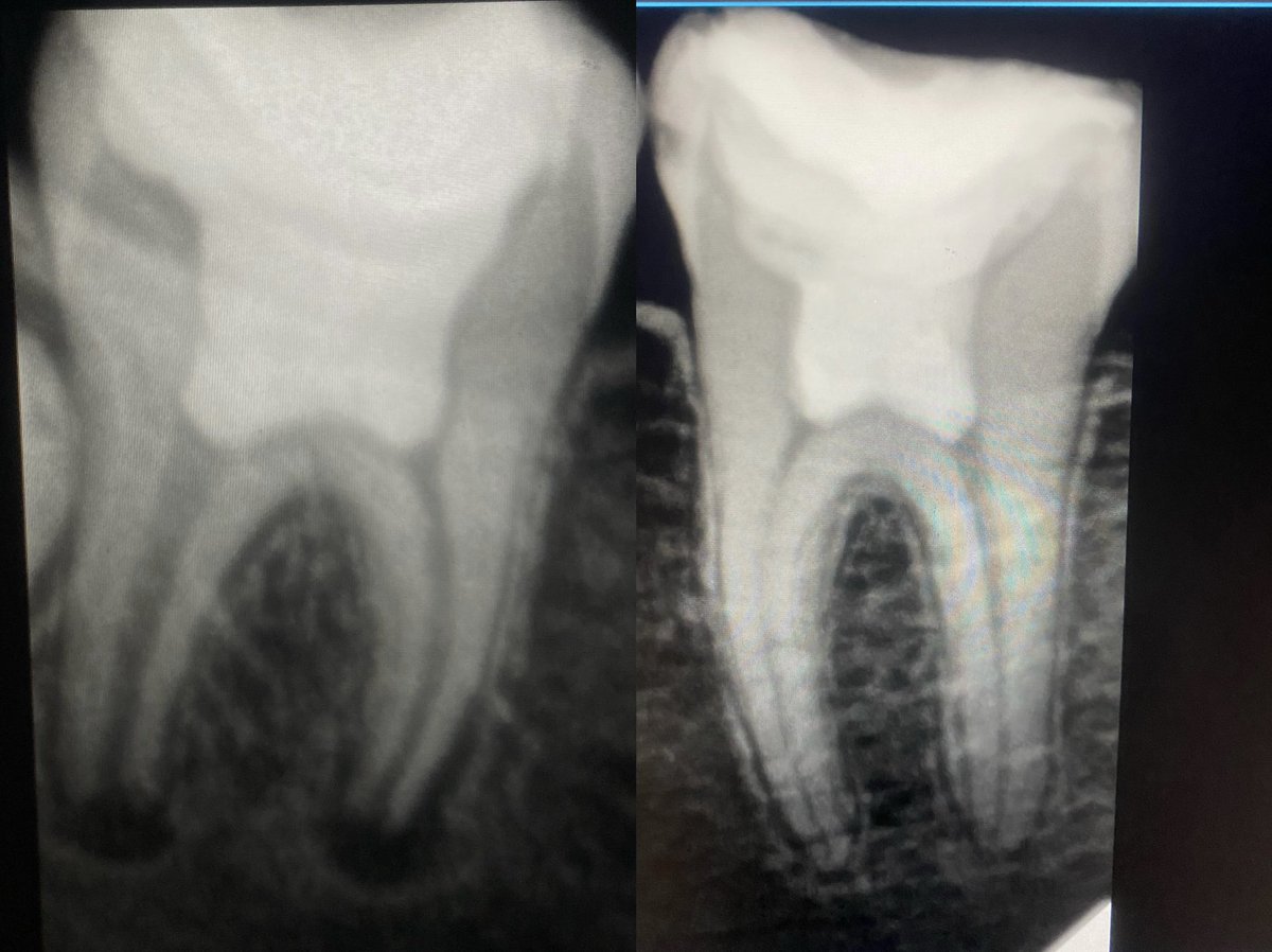 mo_mtaz12345's tweet photo. Vital pulp therapy for lower right(6,7) ,13 years old patient  incomplete root formation at lower 7 so vital pulp therapy,using (MTA,RMGI) followed by composite restoration .

#momtaz_dental_clinic
#خلى_ضحكتك_احلى
Insta https://t.co/5kjR30I5UM
TikTok: https://t.co/pmFwnRd2UL https://t.co/H54xfPi5Gz