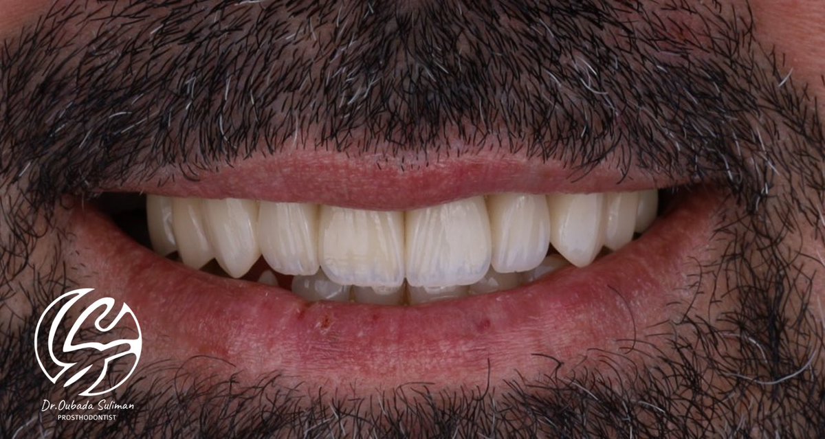 OubaDontist's tweet photo. حالة جديدة و لوغو جديد  فيها تحدي ال preparation for long teeth تحضير الأسنان الطويلة تحتاج مجهود تأني لتجنب ال undercuts و الحفاظ على حيوية الأسنان الي مافيها علاج عصب   و اضاف على الصور جمالية اللوغو الجديد بتصميم المبدعة @madamohammedq https://t.co/VzwFejNkeO
