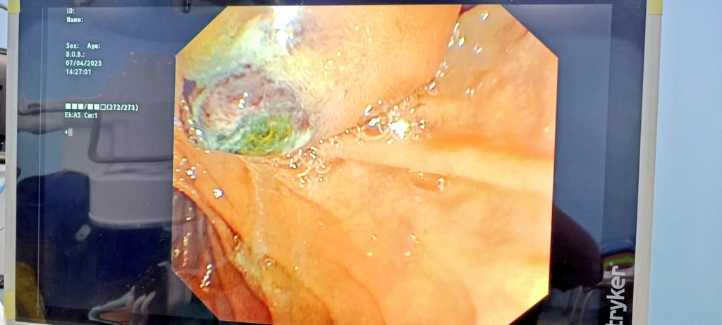 magnetic1ce's tweet photo. #Ampulla you like, but traumatic for the patient !! #GITwitter
The pooping Ampulla and the poop !! https://t.co/SM7ayhGxTt
