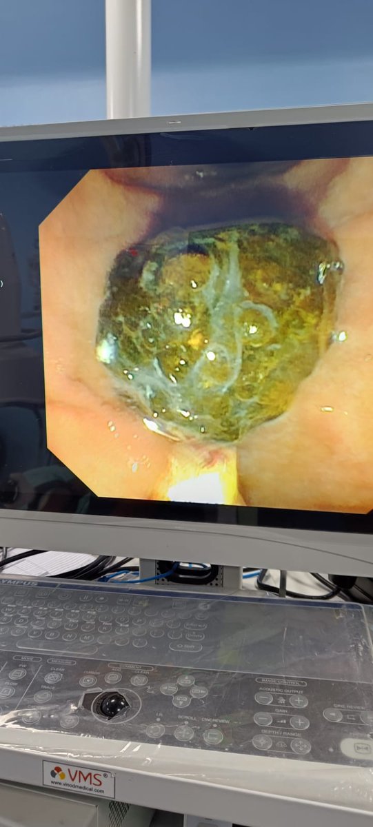 magnetic1ce's tweet photo. #Ampulla you like, but traumatic for the patient !! #GITwitter
The pooping Ampulla and the poop !! https://t.co/SM7ayhGxTt