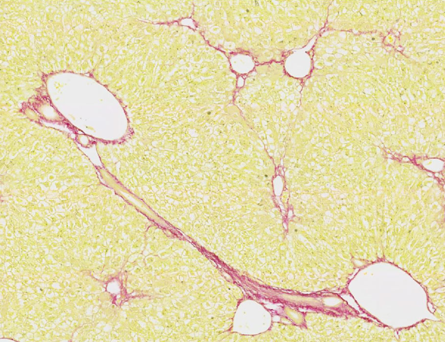 New research from <a href="/Fabre_Thomas_89/">Thomas Fabre</a> <a href="/pfizer/">Pfizer Inc.</a> involving patient and mouse samples unveils 5 protein markers on macrophages suspected to drive #fibrosis in the lungs and liver. scim.ag/2ay