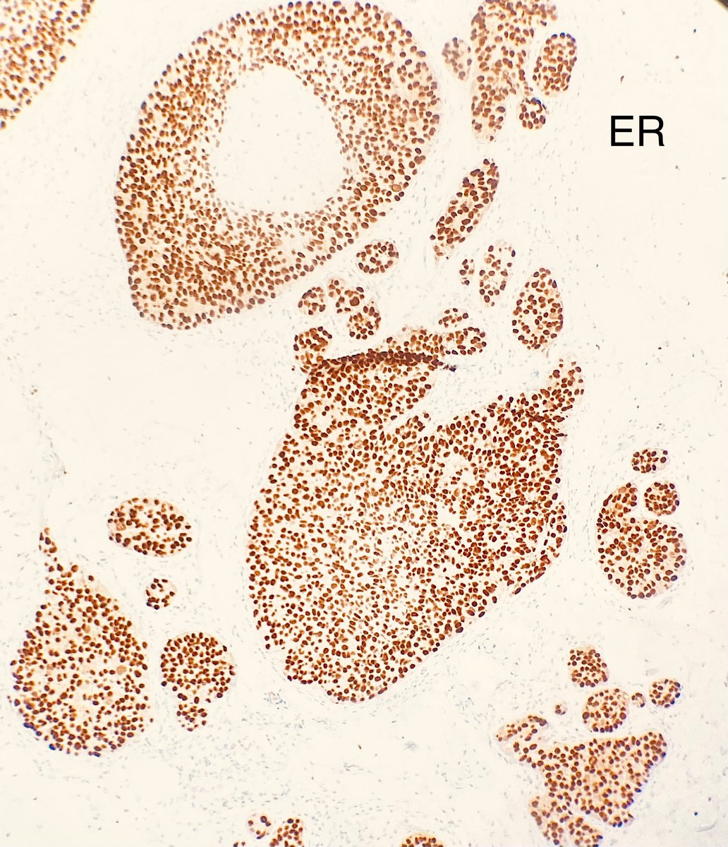 Spotlight on UDH-type DCIS #breastpath #PathTwitter #pathology #pathfellow #MedTwitter @Janiranavarro @AGrabenstetter @DrGeeONE