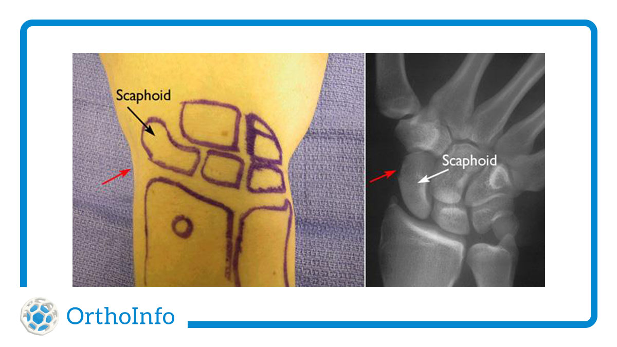 Ладьевидная кость лучезапястного сустава. Перелом ладьевидной кости рентгенограмма. Ладьевидная кость запястье перелом. Ладьевидная кость лучезапястного сустава. Ладьевидная кость запястье перелом.