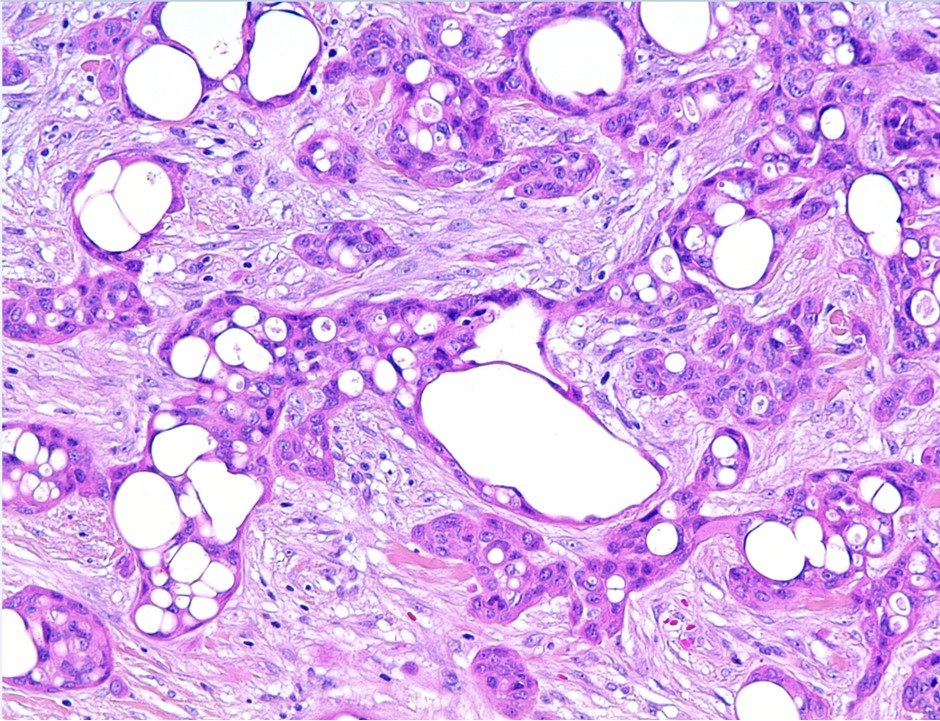 Just realized the new WHO  blue book now considered 'Cribriform Apocrine Carcinoma' as 'Cribriform Tumor' ...  so the #dermpath field will just be like the #hemepath world, from 'lymphoma'  to lymphoproliferative disorder -LPD. IT IS SO CONFUSING (images are from WHO book)