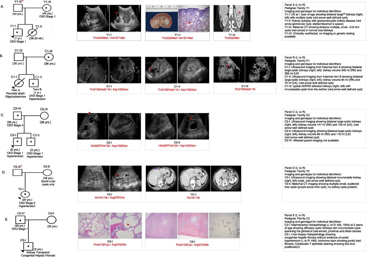 ASNKidney360's tweet photo. ADPKD is widely recognized as the most common single-gene cause of progressive CKD. This study shows ADPKD manifesting earlier than expected on the basis of family history can identify clinically tolerant PKD1 alleles with reduced expression https://t.co/FAFPoqqCpC https://t.co/SuSRFNkt9U