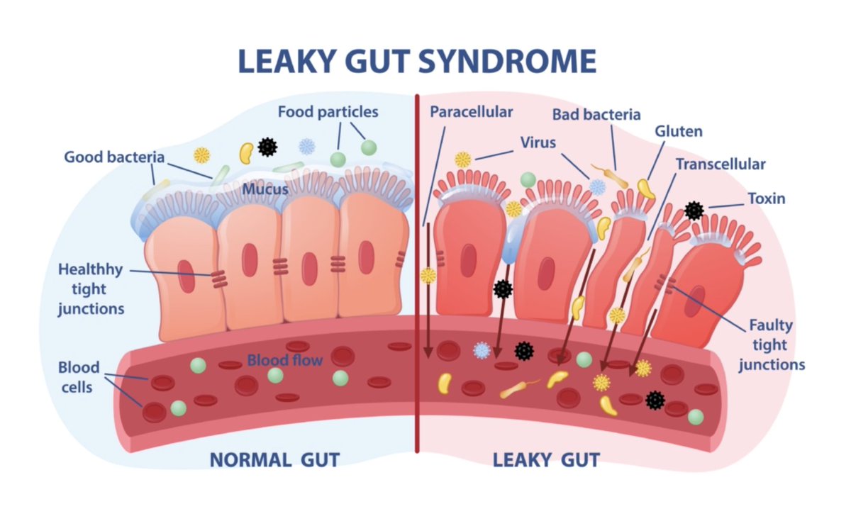 Leaky gut accompanies nearly every other gastrointestinal condition

AND

most neurological / psychiatric conditions as well

How do you fix?

- Sodium Butyrate
- Goat Colostrum 
- Sun / Red Light
- L-Glutamine
- Bone Broth
- Sucrosomial Zinc
- Niacin
- Fix dysbiosis
- Fix diet