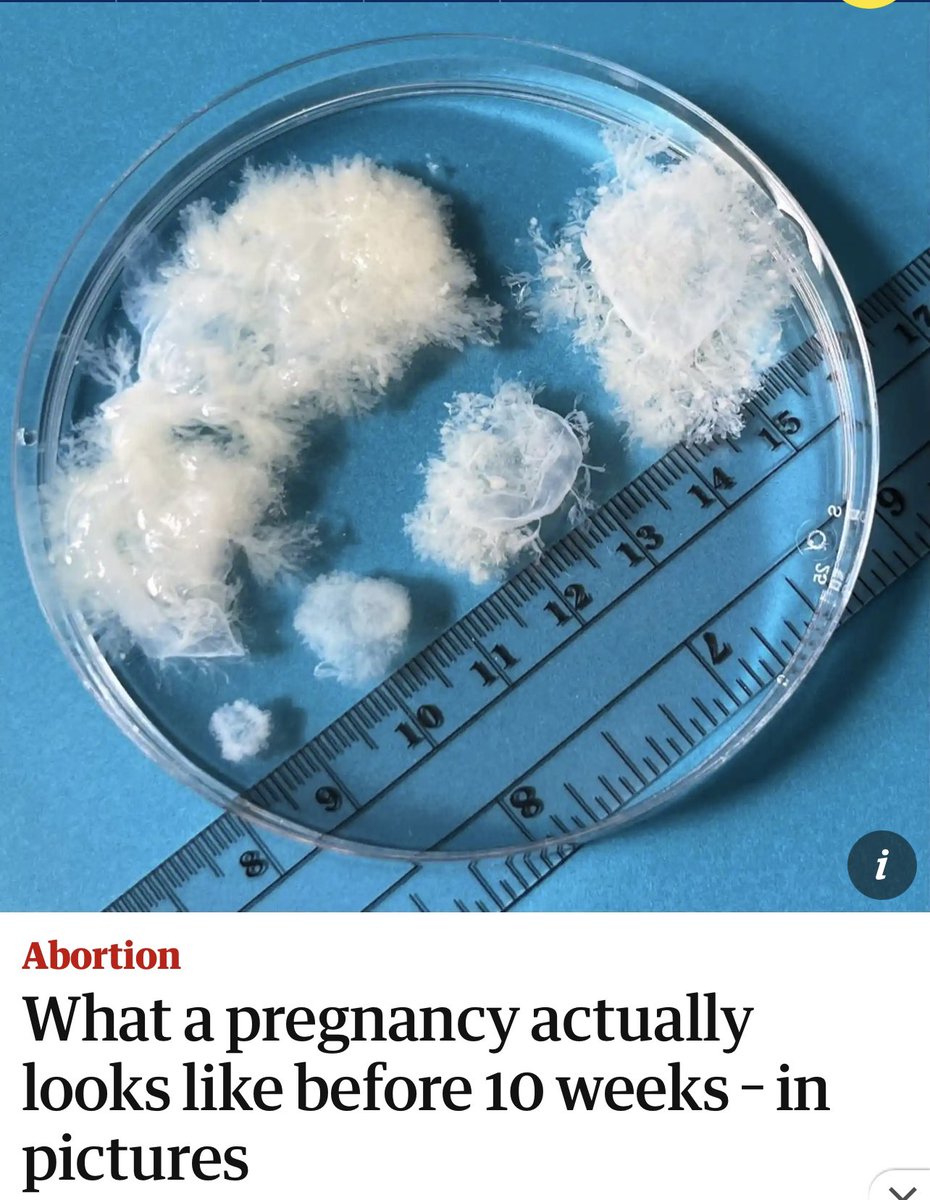 To top it off, Judge Kacsmaryk rejects the term "fetus" &amp; uses "unborn human" or "unborn child" instead. 

He’s literally ruling from the bench based on his religious beliefs. 

Whatever you do, don’t RT this picture of what a pregnancy looks like at 10 weeks.

Don’t do it.