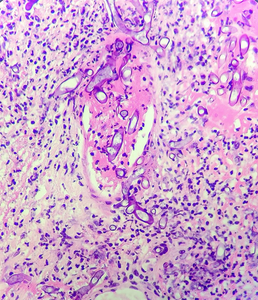 Mucormycosis of the stomach with angioinvasion. 

Don't have to go egg hunting to find these broad irregular fungal hypahe forms 😜

Happy Easter you all!!

#PathTwitter #MedTwitter #Residentlife