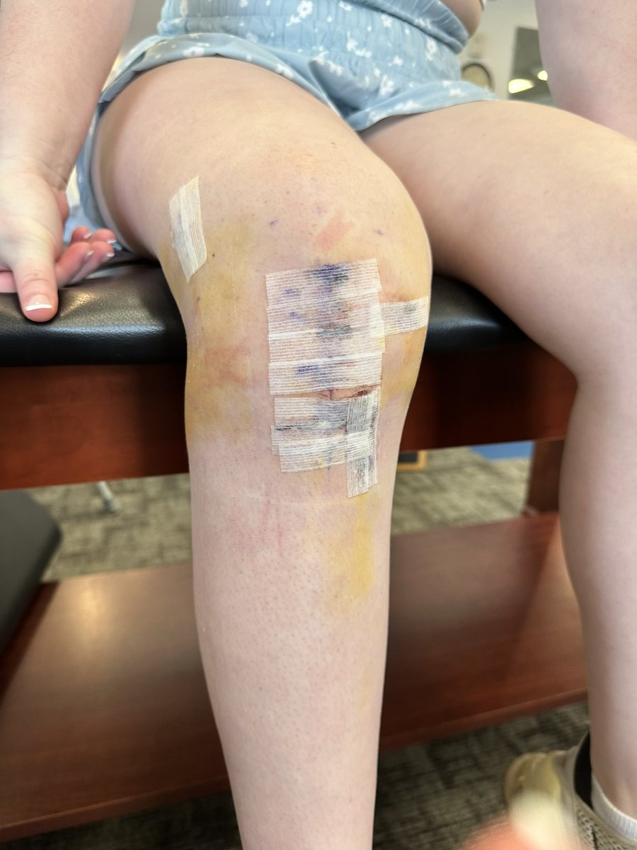 sofia412curtis's tweet photo. Officially one week post op! 💪🏼🦿@ACLclub @ACLrecoveryCLUB https://t.co/hpX6J6JyIV
