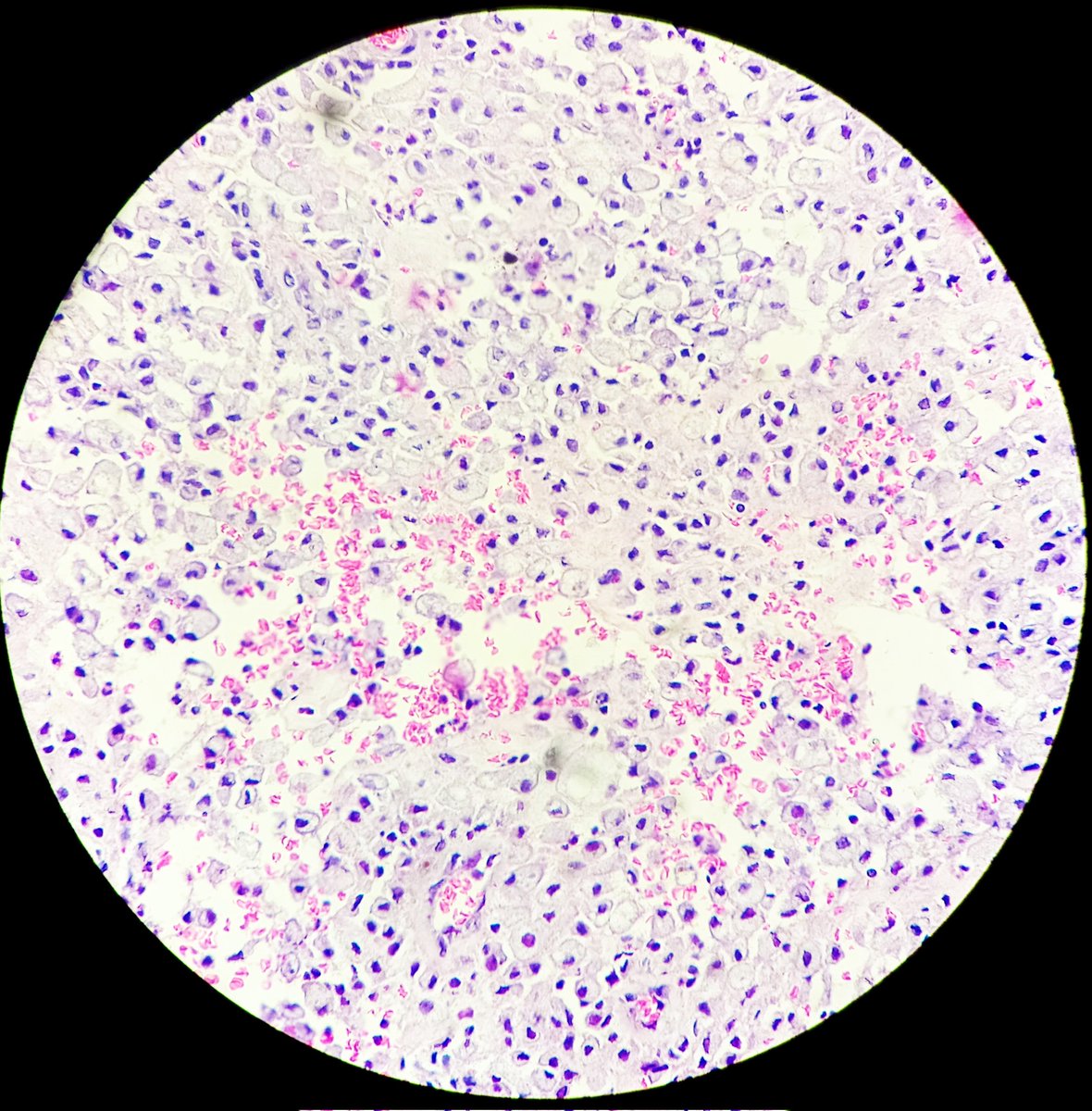 SyedSal55391459's tweet photo. #histopath
#immuno
#CD68
Section (L) showing image of vertebral curettage tissue. Image(Rt.)- CD68.
C/D : Pott's disease.
Looks like full of atypical cells. Suspected secondary.
PAS -ve, CK -ve, CD68 +ve.
Immuno ruled out metastasis. https://t.co/4hWNHxRyp7