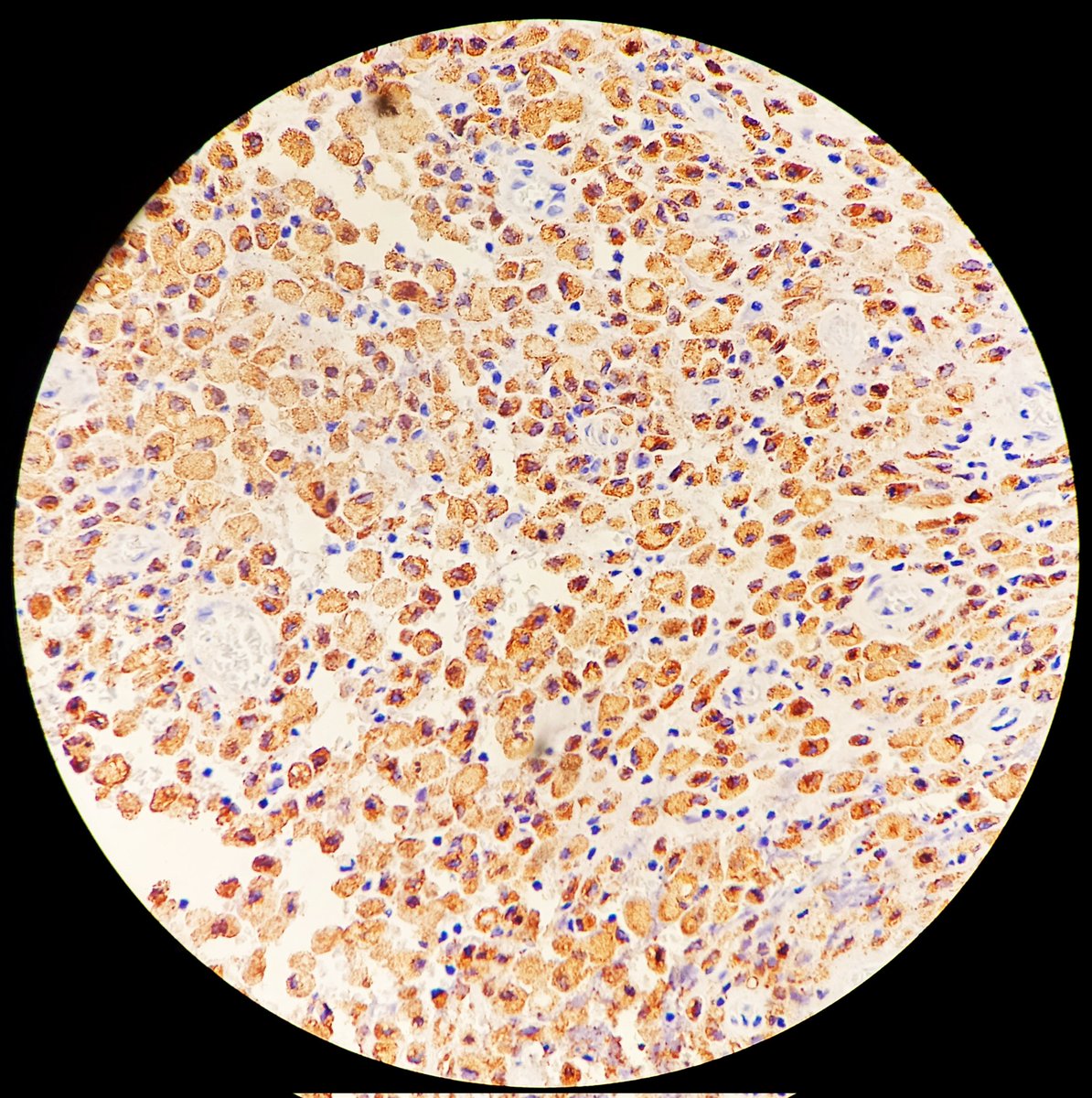 SyedSal55391459's tweet photo. #histopath
#immuno
#CD68
Section (L) showing image of vertebral curettage tissue. Image(Rt.)- CD68.
C/D : Pott's disease.
Looks like full of atypical cells. Suspected secondary.
PAS -ve, CK -ve, CD68 +ve.
Immuno ruled out metastasis. https://t.co/4hWNHxRyp7