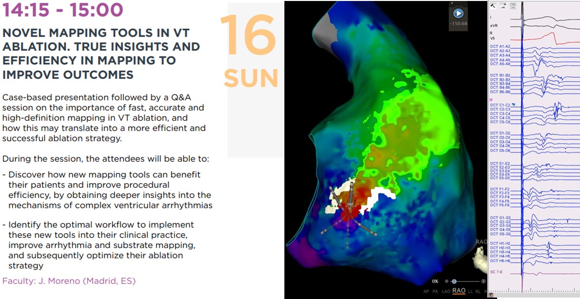 Preparing a really cool presentation for EHRA. Carto symposium on newest Late Potential automatic tracking version. We will be presenting our scar-related VT workflow. Limited room. Contact Carto rep. I enclose QR below
