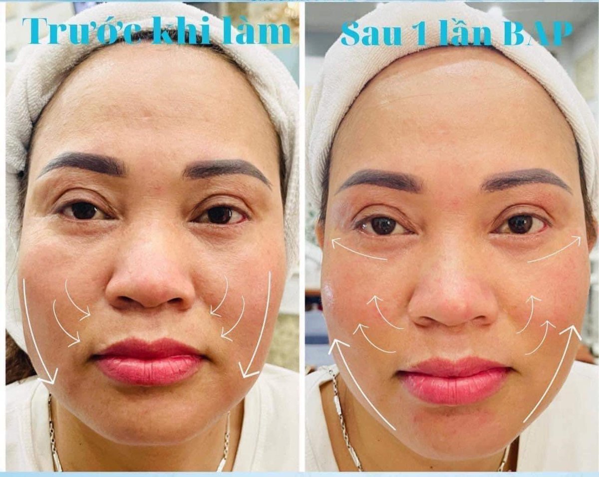 MiSa_Spa's tweet image. 𝐏𝐏 𝐁.𝐀.𝐏 𝐭.𝐢𝐞̂𝐦 đ𝐢𝐞̂̉𝐦 𝐭𝐡𝐚̂̉𝐦 𝐦𝐲̃ 𝐬𝐢𝐧𝐡 𝐡𝐨̣𝐜. Phương pháp này chứa chứa nồng độ HA tinh khiết rất đậm đặc tới #64mgHA, tăng đến 12 lần #colagen và #elastin so với các phương pháp cũ:
✅ Trẻ hóa căng bóng da
✅ Làm đầy các mô mặt