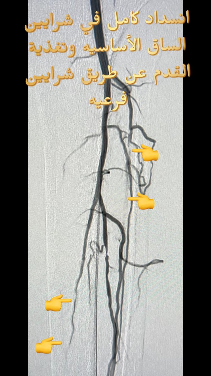 Dr1Irad's tweet photo. مريض في الخمسينيات من عمره كان يعاني من الم شديد في القدم و #غرغرينا في الأصابع بسبب انسداد #شرايين الساق الرئيسية تم فتح ٢ منها بواسطة #قسطرة #الأشعة_التداخلية ولله الحمد. #القدم_السكري https://t.co/7eatMOXptH