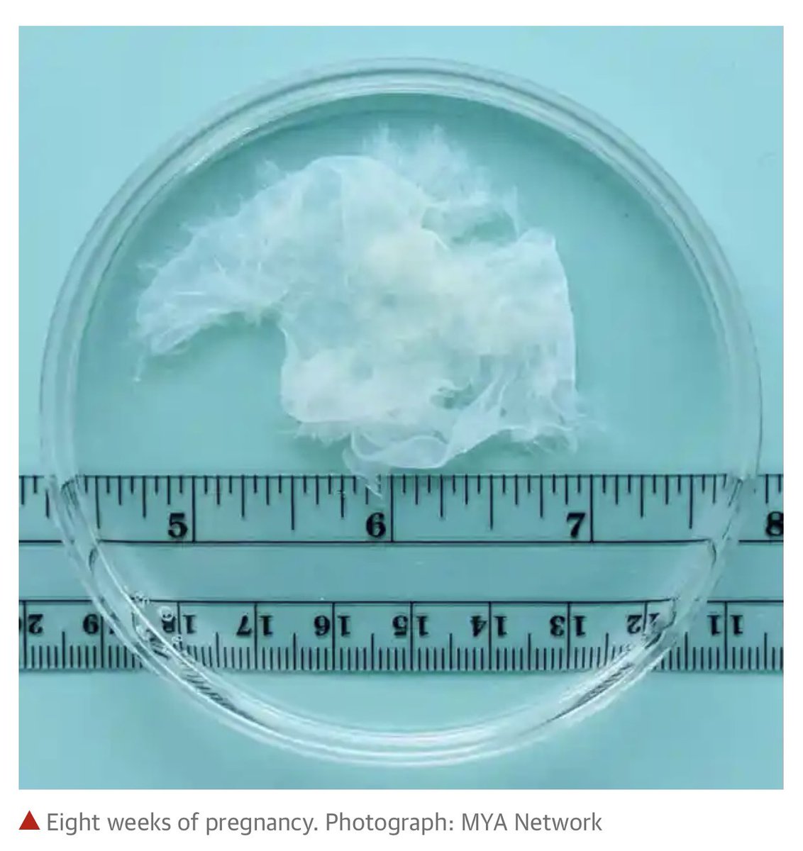 tedlieu's tweet photo. Mifepristone is for abortions of less than 10 weeks. Below are pictures of pregnancies at 6, 7, 8, and 9 weeks.

Are those pictures of human beings? I don’t know. But I do know this: that decision should be made by the woman, not by GOP politicians or religious fanatic judges. https://t.co/MKQ8xeHbVv