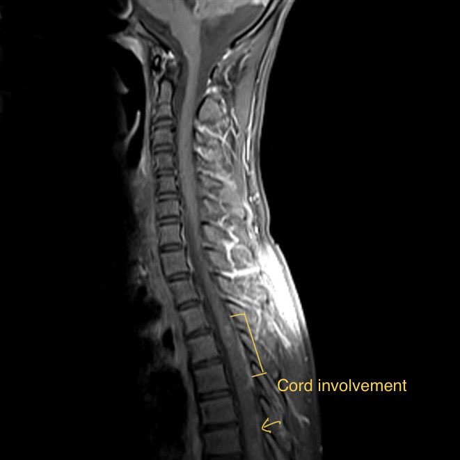 ramandoc's tweet photo. 🧠 Child w/ subpial cysts + meningeal enhancement and hydrocephalus ?
🤔 racemose NCC,?TB? No!‼️
Don't forget the dreadful 💥 diffuse leptomeningeal glioneuronal tumor! ✅
#PediatricNeuro
#radtwitter #Radres #foamrad #Rarecases #Neurorad #neurology #pathology https://t.co/e2BzWiAfzQ