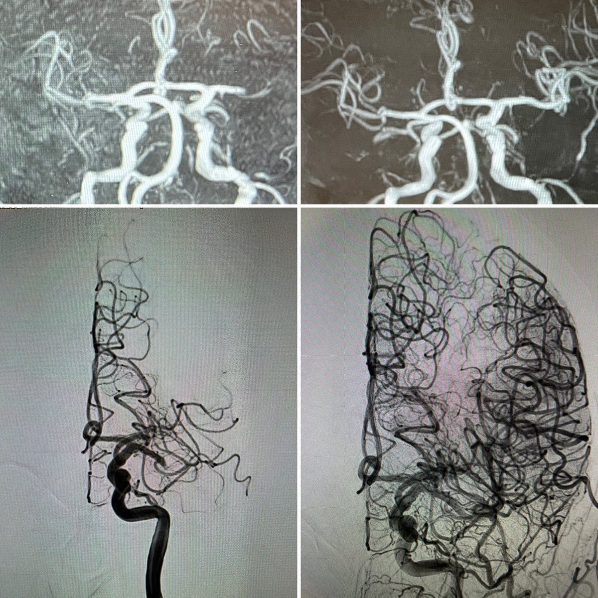 ordomd's tweet photo. 🚨 Stroke code: L-MCA, Extended window, ADAPT ➡️TICI 3 reperfusion 

🚨 Código stroke, ACM izquierda, trombectomia por aspiración ➡️TICI 3 
#nofreeweekends #stroke #brainawarenessweek #diadelneurocirujano #neuroteamcuu #embolia #derramecerebral #neurotwitter #INR #Neurosurgery https://t.co/9ULc59QCRn