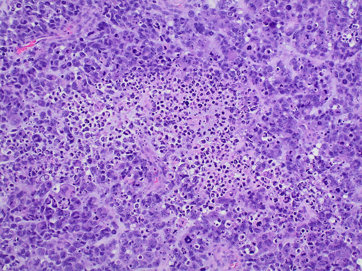 Permanents with a surfeit of atypical mitoses, cell cannibalism (i.e., entosis), monstruocellular pleomorphism, and necrosis.