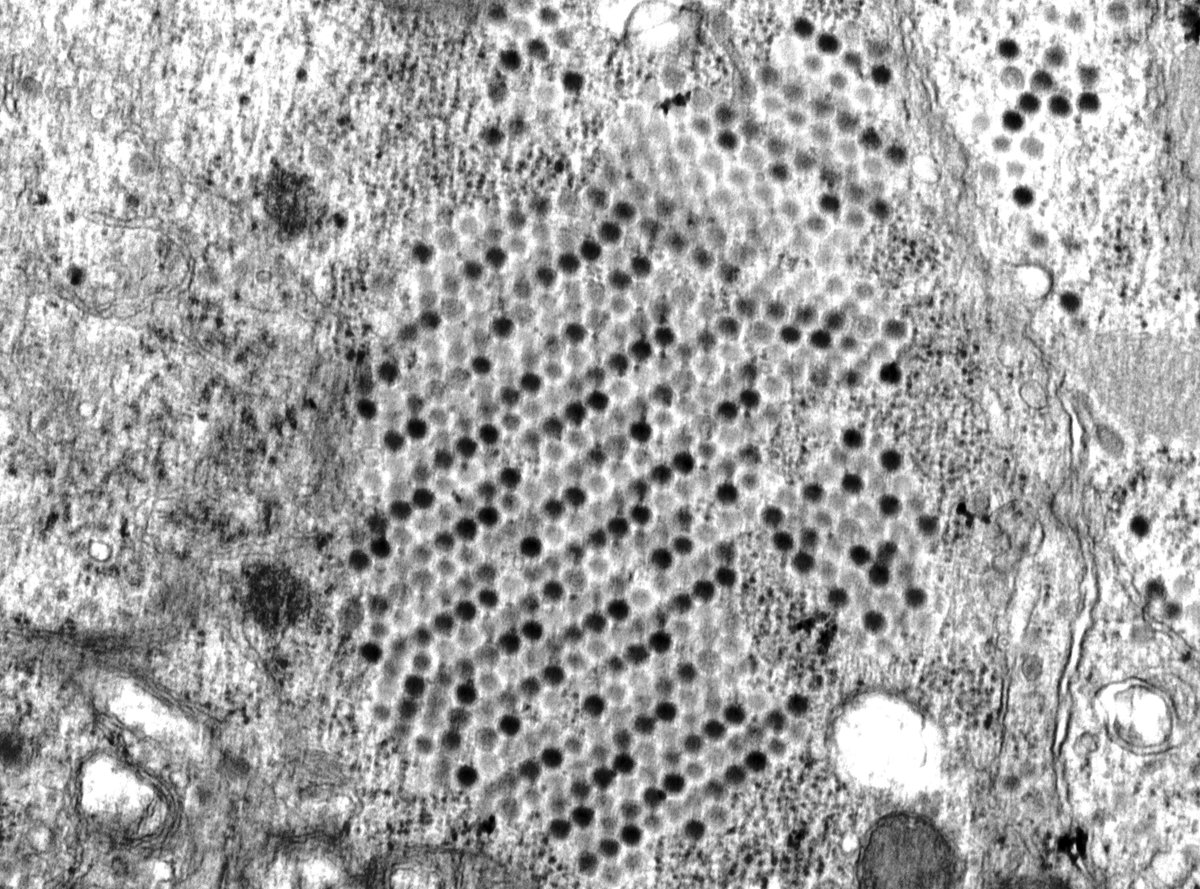 Adenoviral particles by EM of infected tubular epithelial nuclei. The particles are crowded together and arranged in crystalline arrays. #renalpath #transplant