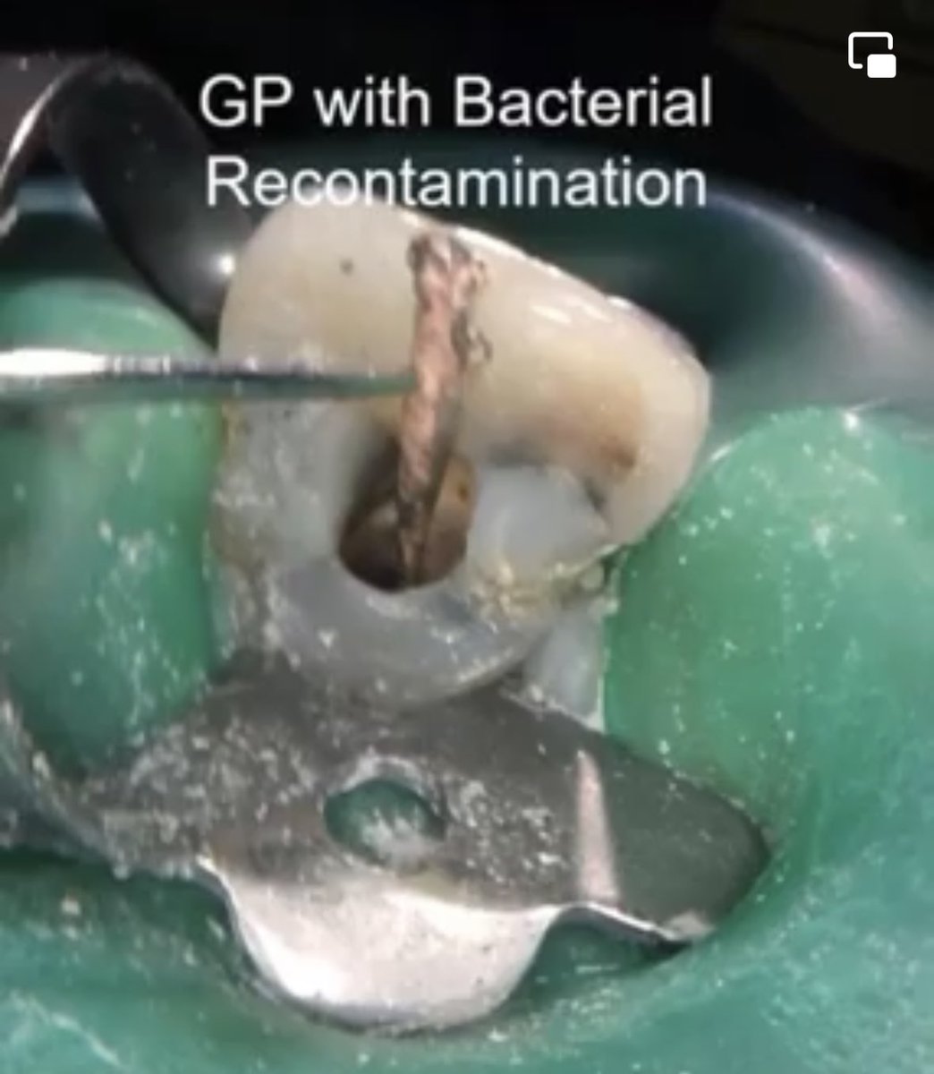DrRicoShort's tweet photo. Large Lesion Treated With The Aid Of 3D CBCT and Bioceramic Technology. #drricoshort #endodontics #rootcanal #retreatment #dentistry #cbct #bioceramics #anatomy https://t.co/sMQbYutrni