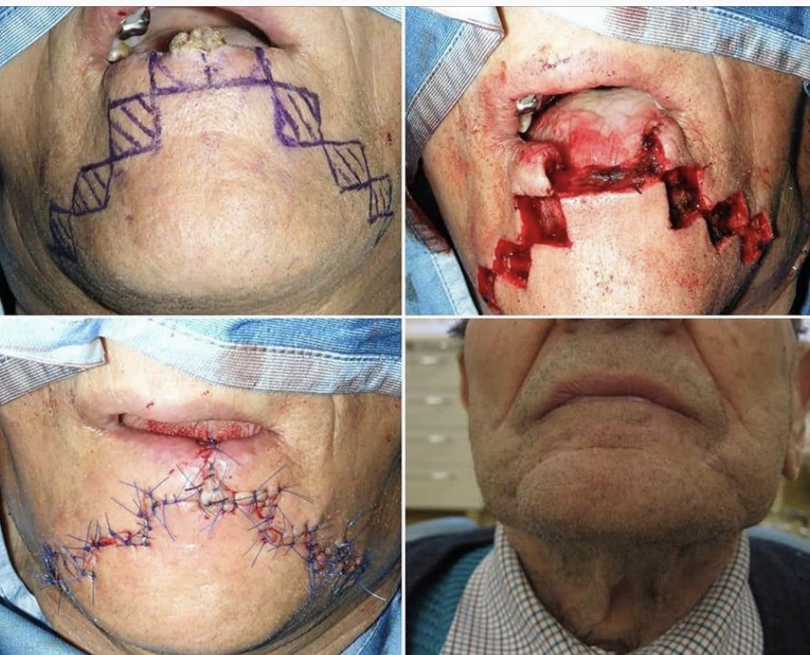OGdukeneurosurg's tweet photo. Very cool surgery: Squamous cell carcinoma of the lip reconstructed w/ 
"staircase" flap technique. Looks like a video game… https://t.co/KwpEZIfgxd