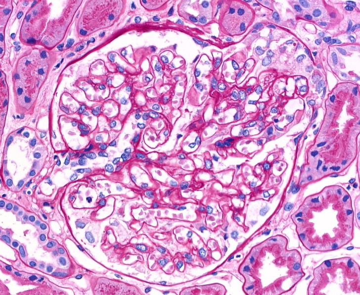 50 yo M with nephrotic syndrome. Tip lesion by LM, but finely granular IF staining of GBM. Many subepithelial deposits by EM. Actually a case of PLA2R- associated membranous nephropathy #renalpathology #fsgsisapatternofdisease
