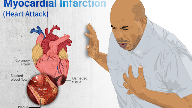 Hlth_matters's tweet photo. Heart attack is a serious medical condition that occur when the blood flow to your coronaries is blocked.

https://t.co/UqsengaQDb https://t.co/R2IK6qN8oR