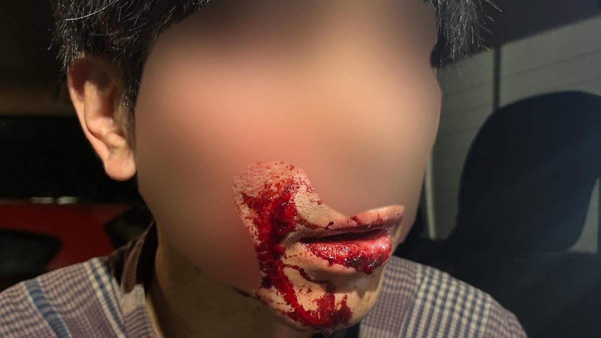 A man suffered serious facial injuries after he was allegedly punched in the head, repeatedly kicked in the face and robbed while walking along Riverside Drive in Perth. bit.ly/3KouO9M