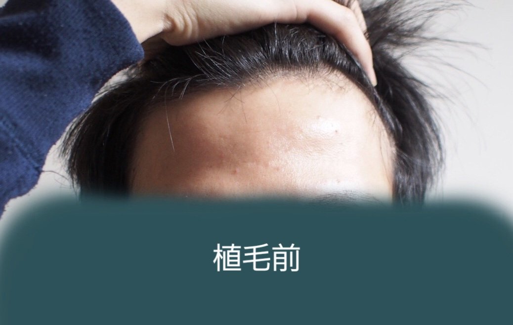 Uetakun_com's tweet photo. 植毛して5年半経って今こんな感じです👀
ブログ記事→https://t.co/mD6oBVdoe1 https://t.co/9Qj81lYhv9