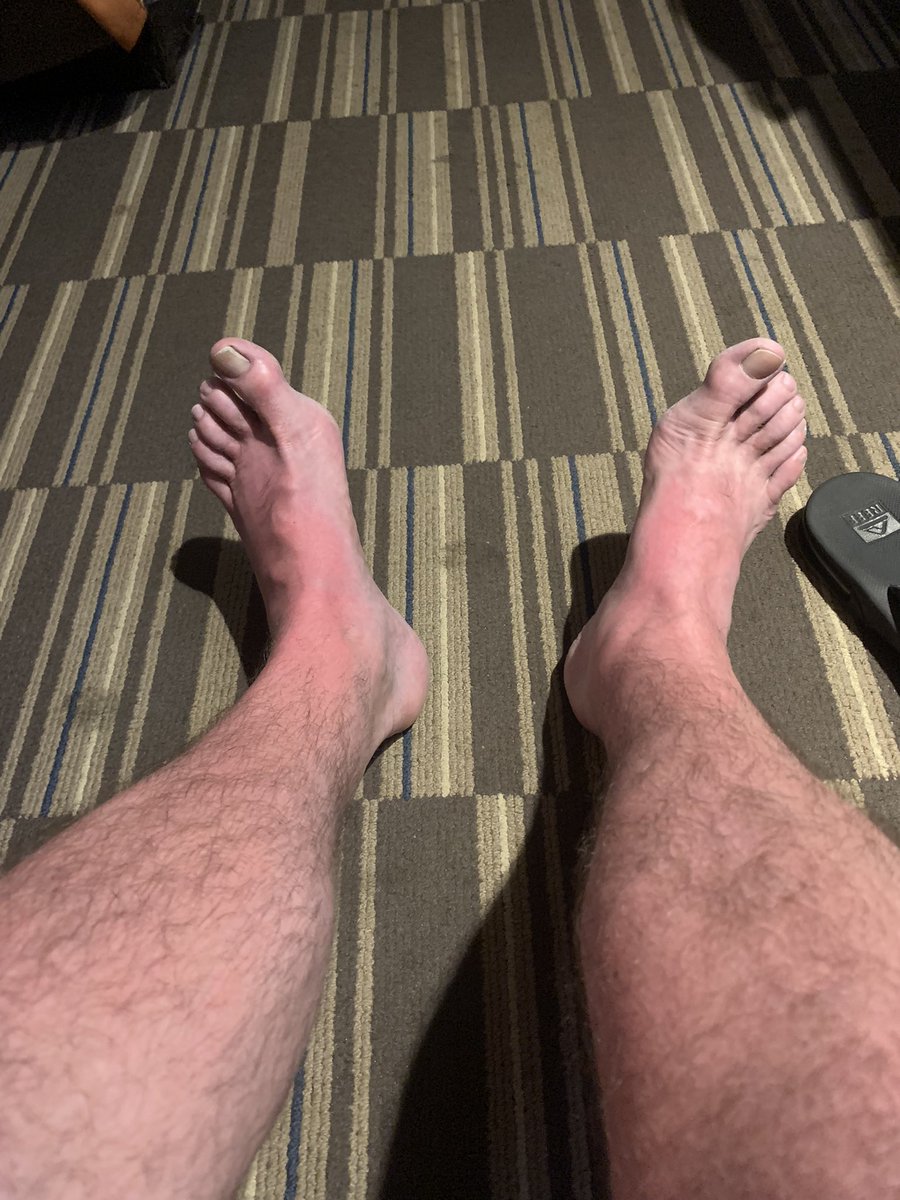 jonlewerer's tweet image. Got some sun, and kankles today. Wtf?