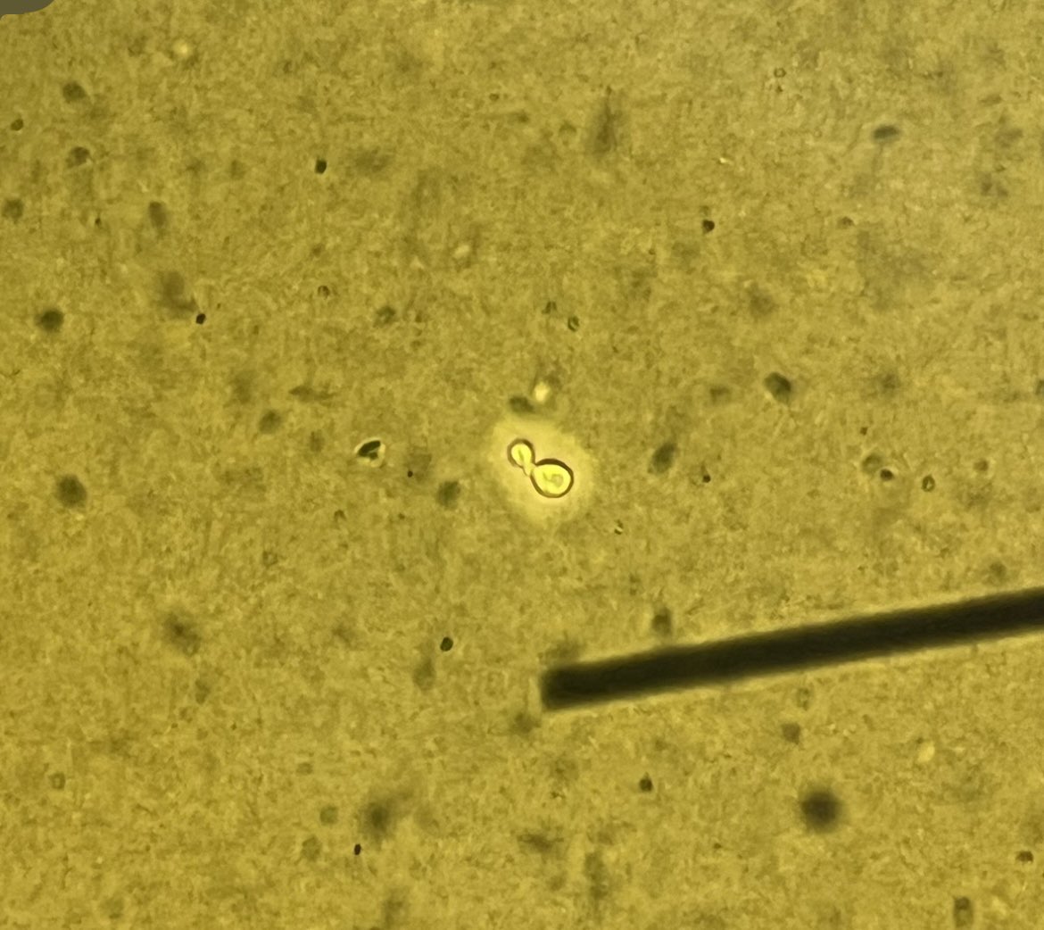 ผู้ชายไทยอายุ 23 ปี LGBTQ มาด้วยประวัติไข้เรื้อรัง 2 สัปดาห์และมีอาการปวดศีรษะมาก ตรวจร่างกายพบภาวะคอแข็ง (stiffness of neck positive) สงสัยภาวะเยื้อหุ้มสอมงอักเสบ(meningitis) จึงทำการเจาะน้ำไขสันหลังไปตรวจ (cerebrospinal fluid)
India ink: encapsulated budding yeast