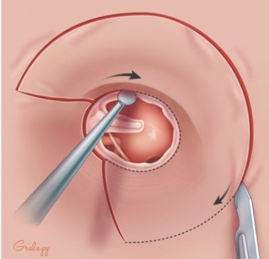 Did you know that tympanoplasty surgery can restore your hearing? Tympanoplasty is a surgical procedure that repairs a perforated eardrum, helping to restore hearing in individuals with hearing loss due to eardrum damage. #Tympanoplasty #HearingRestoration #EarSurgery