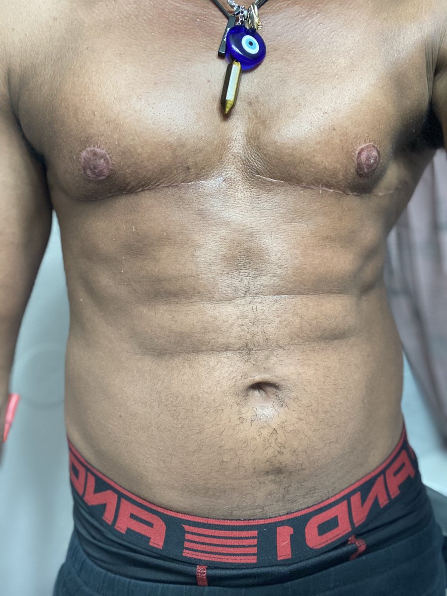 thorprototype's tweet photo. Almost 4 months post op all three of my surgeries! 2nd stage coming SOON 🧿🥹💫😈🖤 🍆 #TransNiggaTakeover #3surgeries #phalloplastystage2 #recovering #lookingrealnice #transmenofcolor https://t.co/ftHqmgbQMX
