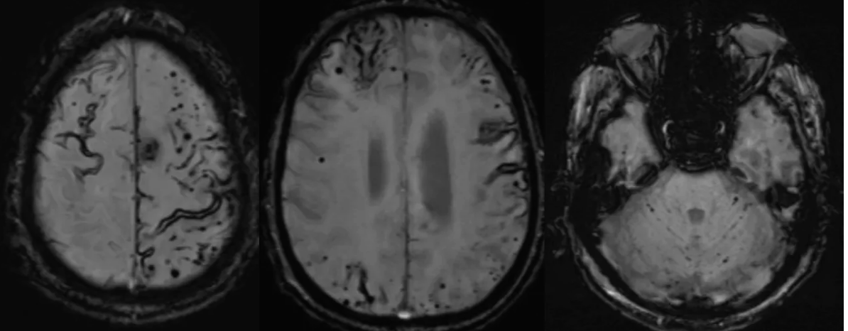 vebinars_neuro's tweet photo. 🔷Adult patient with bilateral sensorineural hearing loss &amp; ataxia

https://t.co/4073CP8bmu

#vebinars #value_based_imaging #evidence_based_practice #neurorad #FOAMrad #neurology #neurosurgery #radres #neurotwitter #MedTwitter #FOAMed #MedEd https://t.co/aBPgA69iY5