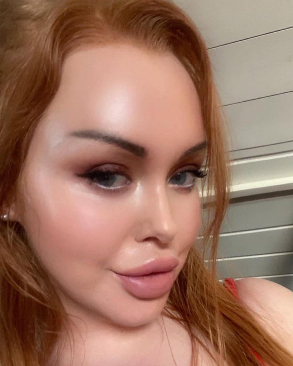 Lipaddictz's tweet photo. @frkidajohansen Lip lift & more filler! ππ #fake #lips #lipinjections #plastic #swollen #lipgap #juvederm #filler #addict #liplift #lipfetish #plasticsurgery #plasticpositive https://t.co/XwWHJRtvaR