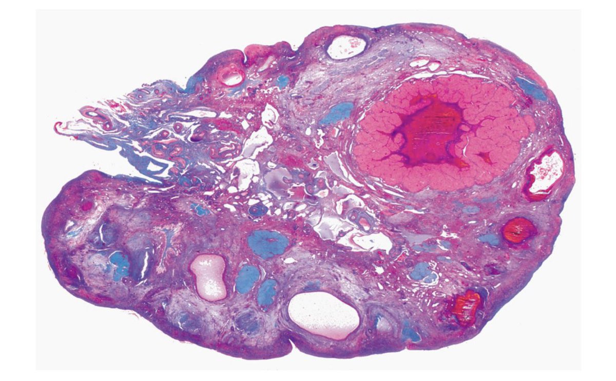 The Koshur Doc (@thekoshurdoc) on Twitter photo Cross Section of a human female ovary.
Can you name the major structures seen?
Isn’t it beautiful?
#histology #MedEd #MedTwitter #ThreadEd
<a href="/IhabFathiSulima/">Dr Ihab Suliman</a> Cross Section of a human female ovary.
Can you name the major structures seen?
Isn’t it beautiful?
#histology #MedEd #MedTwitter #ThreadEd
<a href="/IhabFathiSulima/">Dr Ihab Suliman</a>