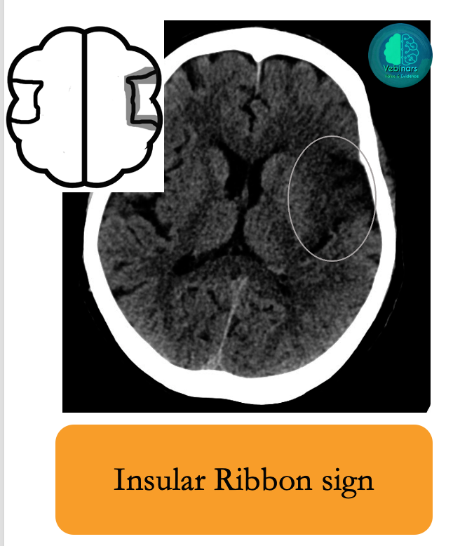 vebinars_neuro's tweet photo. 💡Computed tomography (CT) is the commonest imaging modality done for acute stroke
🔷Here are the signs to spot an acute/hyperacute stroke on CT scan👇
1/3
#vebinars #value_based_imaging #evidence_based_medicine #NeuroRad  #Neurology #stroke #FOAMrad #FOAMed #neurotwitter #MedEd https://t.co/cAF9Bs3xA8