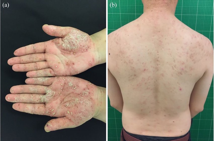 Keith Siau (@drkeithsiau) on Twitter photo Patient with IBD presents with joint pains and these skin problems. What’s the diagnosis? Patient with IBD presents with joint pains and these skin problems. What’s the diagnosis?