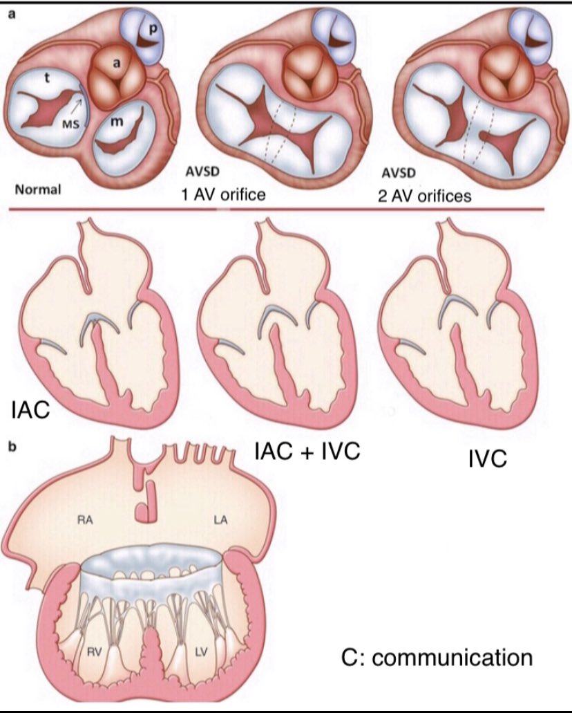 @DrRajeshG1 In ALL types of #AVSD (w or wo interatrial comunicantion, w or wo interventricular communication) have inlet-outlet disproportion. This is due to the presence of a common AV junction w unwedge Ao valve in ALL #AVSD w the Ao V. more anterior/cephaliclly placed.

#CHD #pedscard