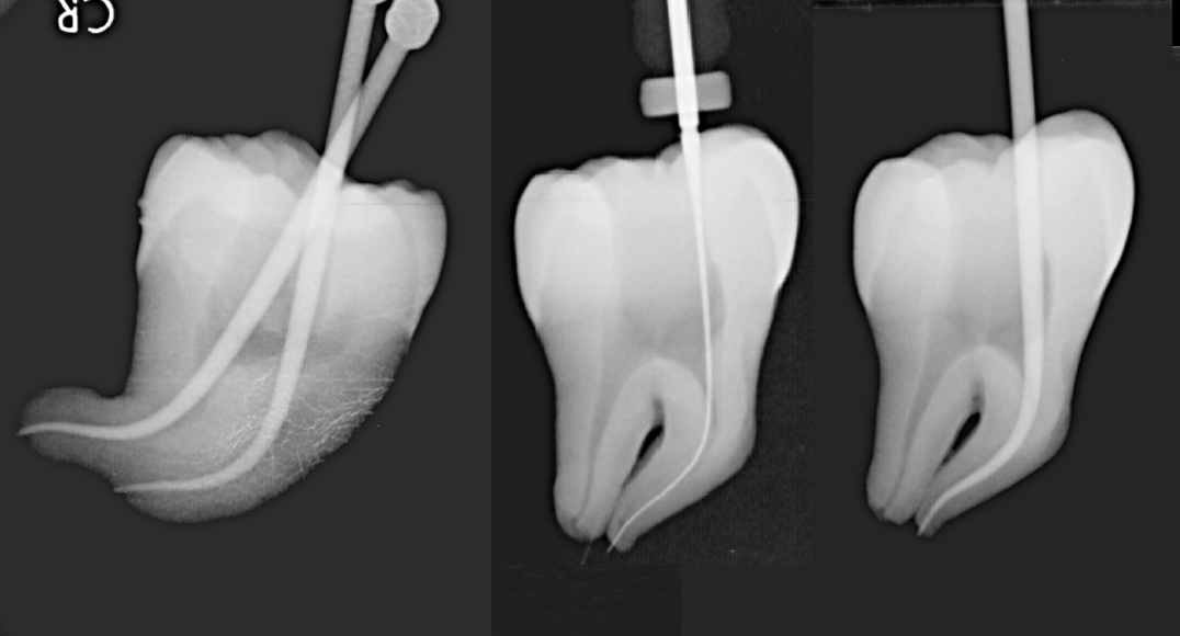 syh91006's tweet image. The Secret of Glide Path Lecture by Dr. Lee, Tsung-Lin
NCKU X KMU Dental Department In-Hospital Courses 

#endodontics
#glidepath