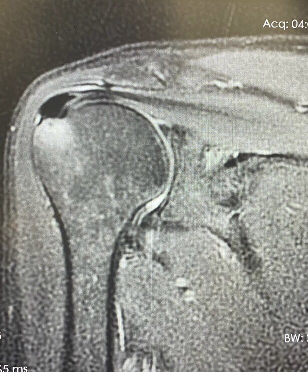 A case of active calcific tendonitis #MedTwitter #radtwitter #diagnosticradiology #MSK #radres #futureradres @AwanRad @HabibollahiSina @usamaanwar49 @UW_MSKrad @KassasMutaz @mahad_minhas @NURadiology