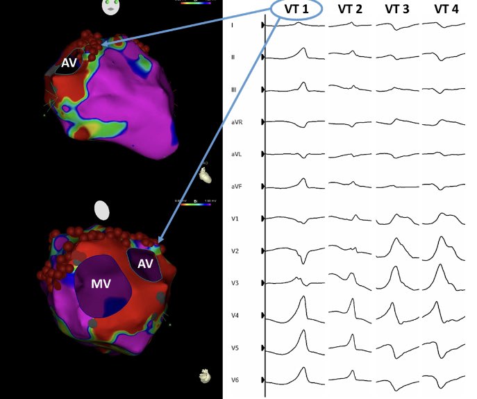 Check out our recently published study of outcomes and characteristics of ⚡️VT/PVC ablation ⚡️in patients with prior AV intervention (surgical/TAVR). @MdTakumi @AliAhmad507 @konsiont @akillumd @EPeeps. pubmed.ncbi.nlm.nih.gov/36994918/