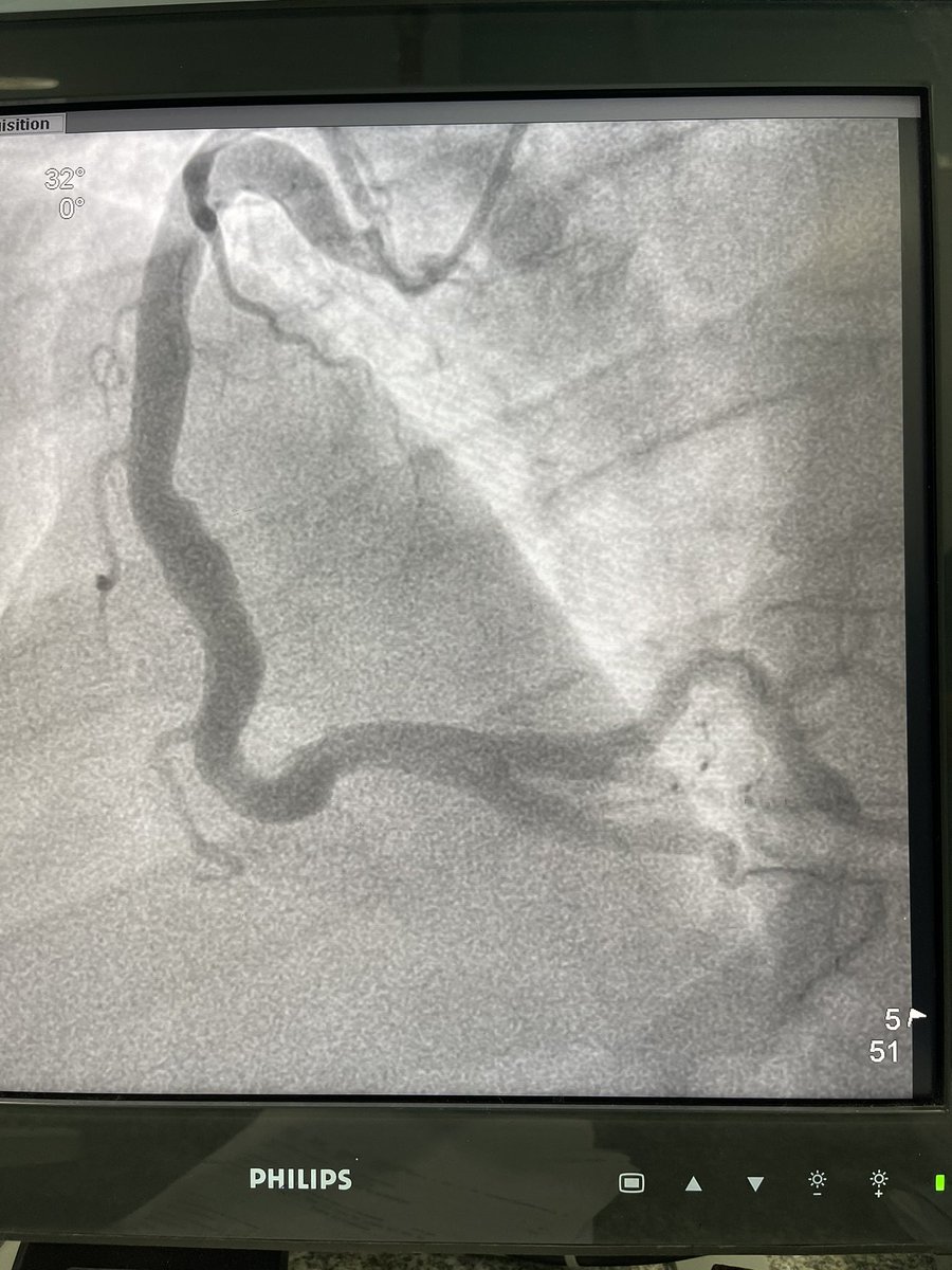 MariaSanali's tweet photo. Male, 42 yo, hipertension since 17yo! Arrived at hospital with STEMI! 6 months after bariatric surgery! Angiography showing a large thrombus in Circunflex artery without an obstrutive lesion! In addition to DAPT , would anyone combine rivaroxabana 2.5mg BID? https://t.co/RiDF71MWr0