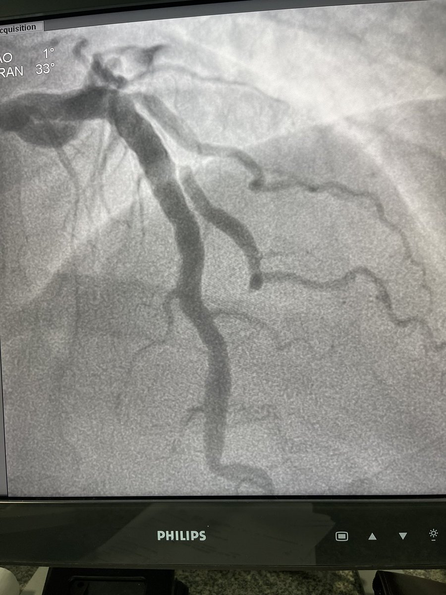 MariaSanali's tweet photo. Male, 42 yo, hipertension since 17yo! Arrived at hospital with STEMI! 6 months after bariatric surgery! Angiography showing a large thrombus in Circunflex artery without an obstrutive lesion! In addition to DAPT , would anyone combine rivaroxabana 2.5mg BID? https://t.co/RiDF71MWr0