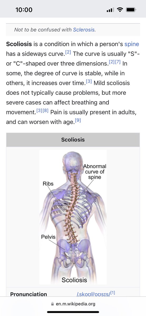Ijeh_Noemie's tweet photo. It’s funny reading the comments and seeing people say she is disabled.

Having a bent posture doesn’t mean she is disabled 🙄🙄. I have a bent posture and I am not disable. 

I have scoliosis😎I am not disabled. https://t.co/Yv5cnRGwsj