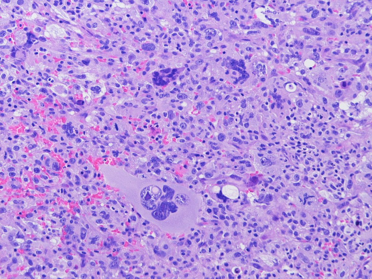 jfhang's tweet image. Needle bx of a large thyroid mass in a 76y/o woman after an inadequate FNA. You can appreciate both tumor and osteoblast-like giant cells at the same spot of this anaplastic thyroid carcinoma. Atypical mitosis is also noted. #thyroid #EndoPath #ENTpath #HeadandNeckPath