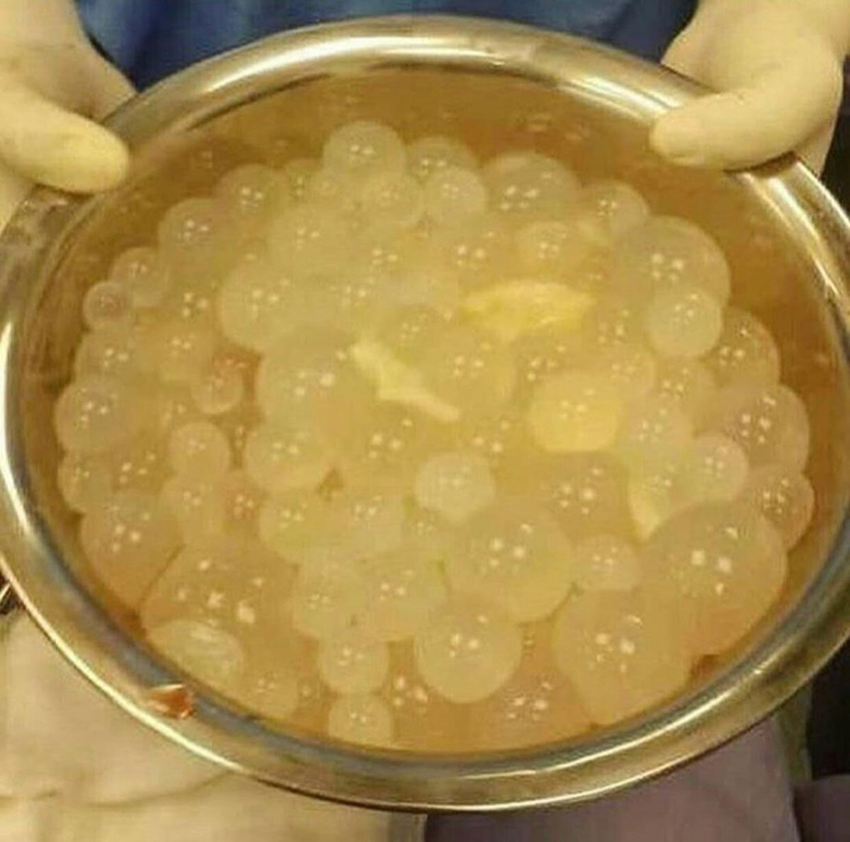 drkeithsiau's tweet photo. An unusual finding during abdominal surgery for a patient with abdominal distension. What’s the diagnosis? https://t.co/ctCmJCzKd3